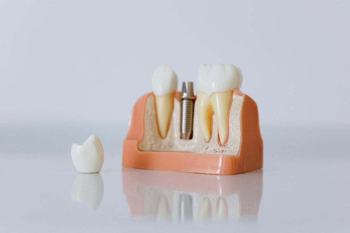 Implants and Endodontics at Neosmiles Dental Care